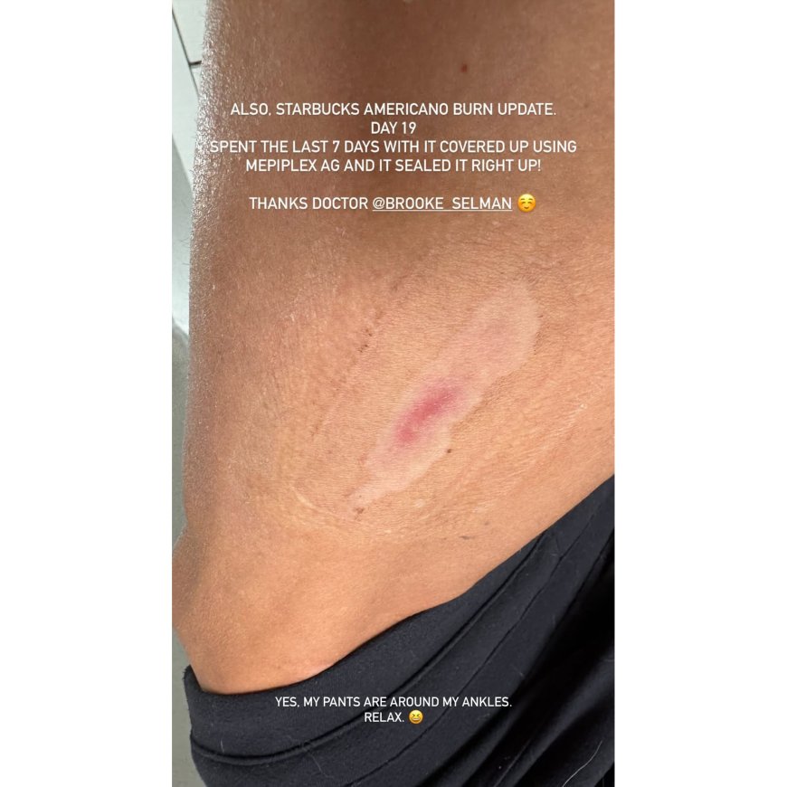 Danica Patrick Offers an Update on Her Nasty Starbucks Burn After 3 Weeks