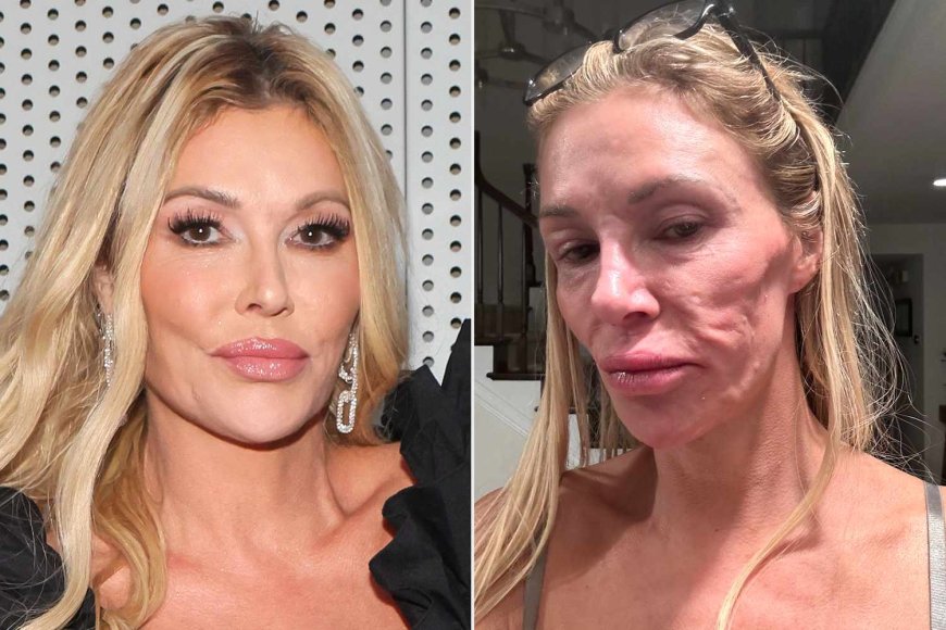 Brandi Glanville Steps Out for First Time Since Dissolving Her Face Filler After 'Parasite' Crisis