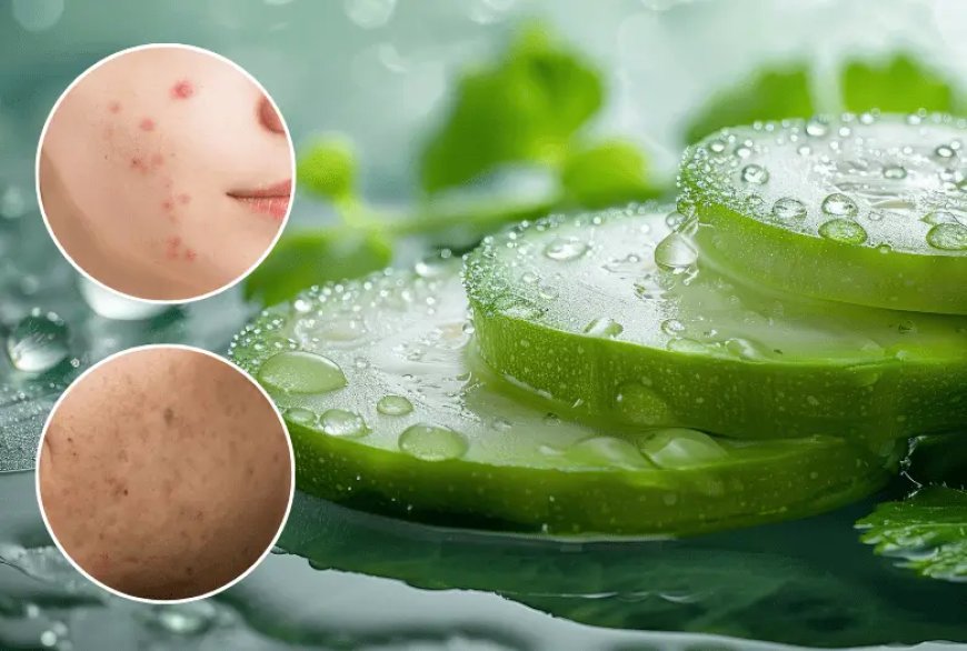 Can Aloe Vera Remove Pimples and Dark Spots: 5 Easy Home Remedies